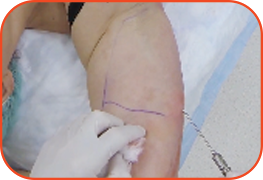 Procedure 3