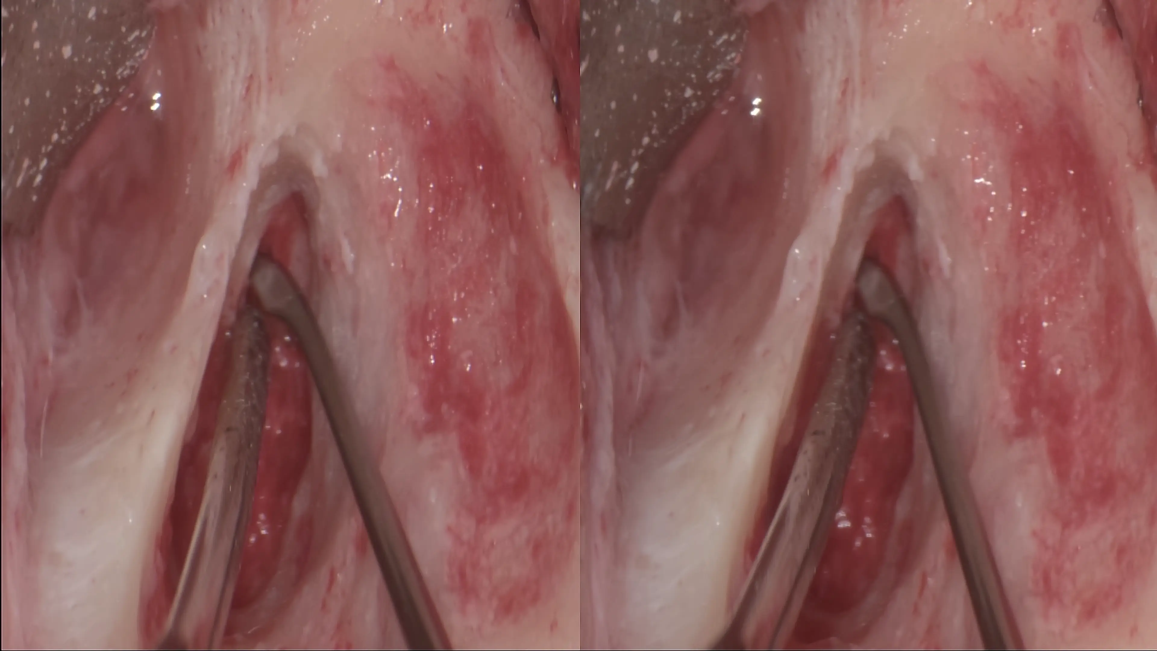 Middle Ear Infection Surgery