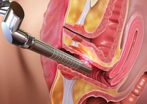 fistula