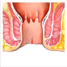 fistula