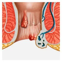 pilonidal-sinus