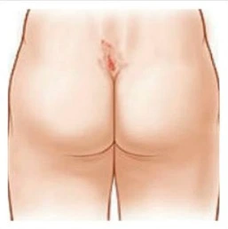 hemorrhoids