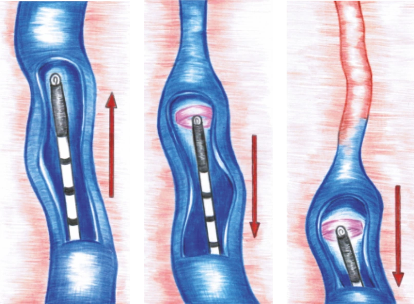 dental-laser